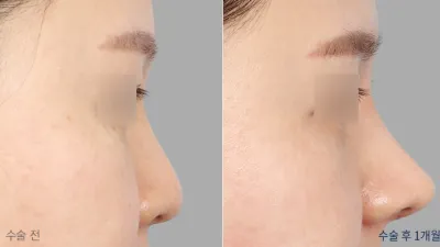 Before & After