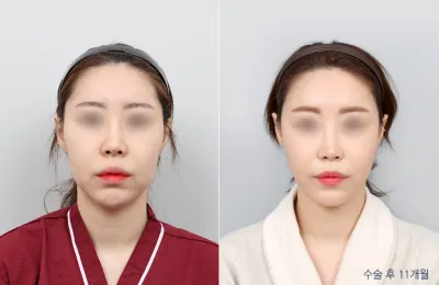 Before & After