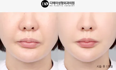 Before & After