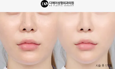 Before & After