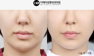 Before & After