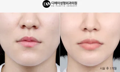 Before & After