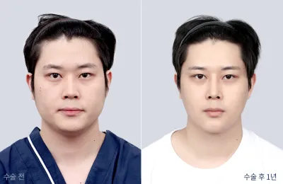 Before & After