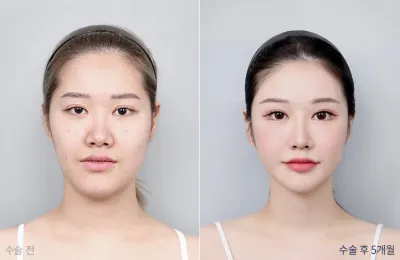Before & After