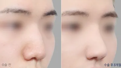 Before & After