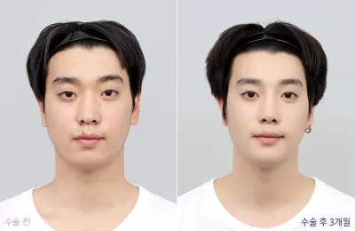 Before & After