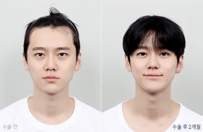 Before & After