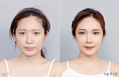 Before & After