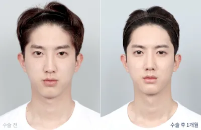 Before & After