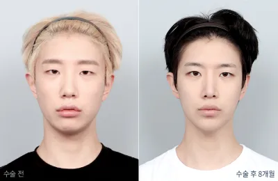 Before & After