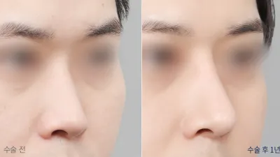 Before & After