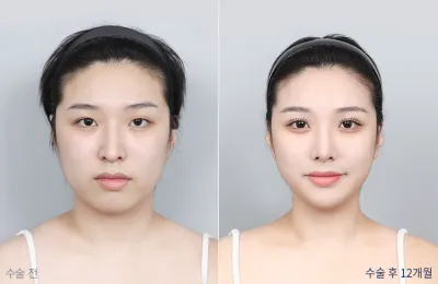 Before & After