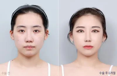 Before & After