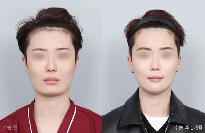 Before & After