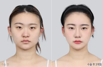 Before & After