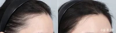 Before & After