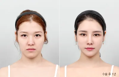 Before & After