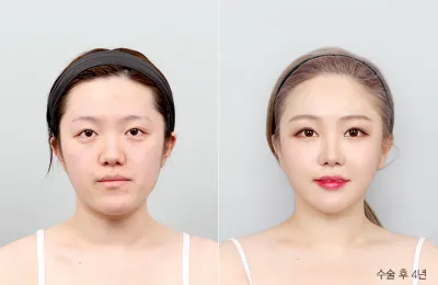 Before & After