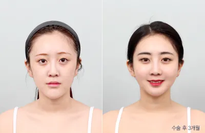 Before & After