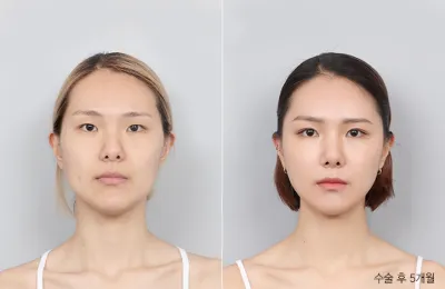 Before & After