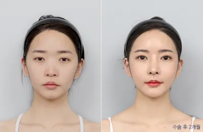 Before & After
