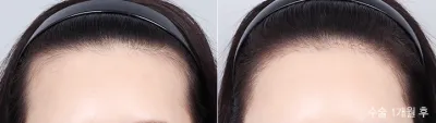 Before & After