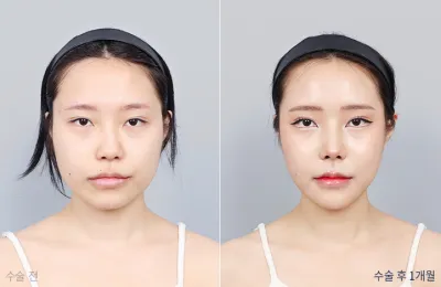 Before & After