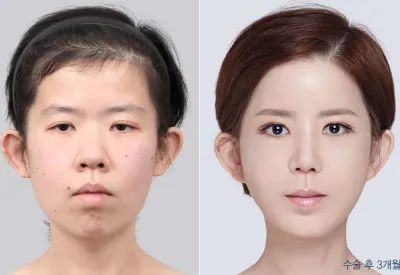 Before & After