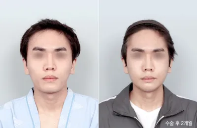 Before & After