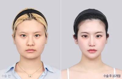 Before & After