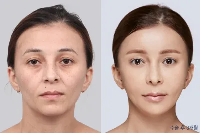 Before & After