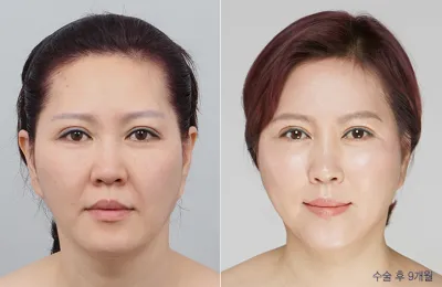 Before & After