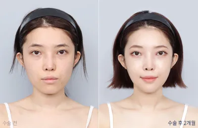 Before & After