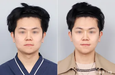 Before & After