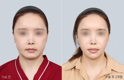 Before & After