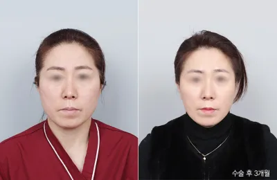 Before & After