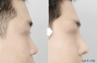 Before & After