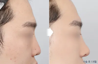 Before & After
