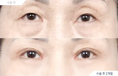 Before & After