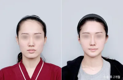 Before & After