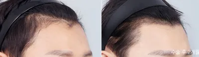 Before & After