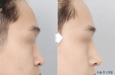 Before & After