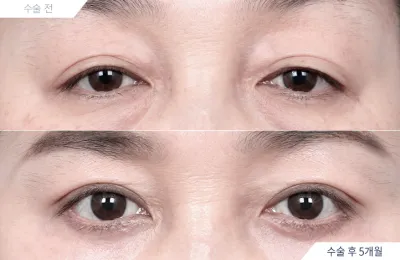 Before & After