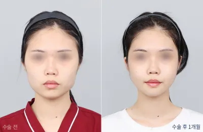 Before & After