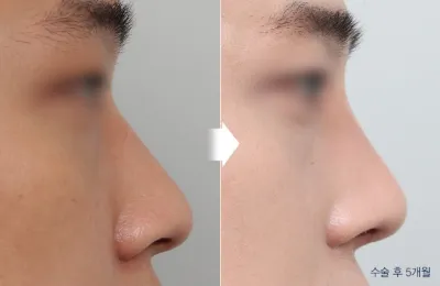Before & After