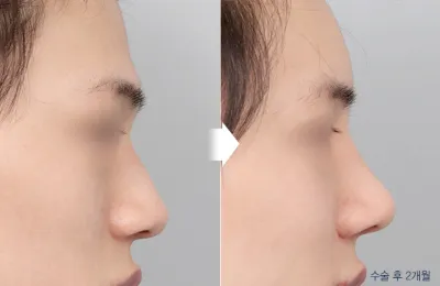 Before & After