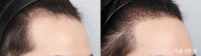 Before & After