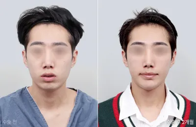 Before & After