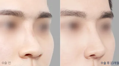 Before & After