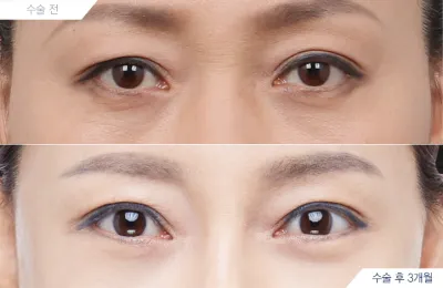 Before & After